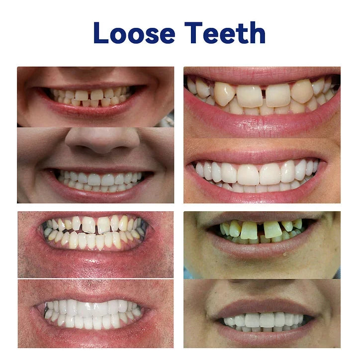 TAILEDEN™-New Generation Flexible Full Denture Solution